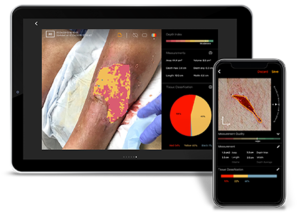 InSight®3D Wound Imaging For Wound Healing